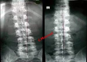 Female Chiropractor Irvine CA Curved Back XRay