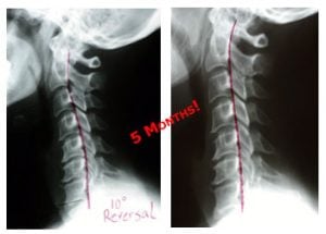 Female Chiropractor Irvine CA Neck X Ray